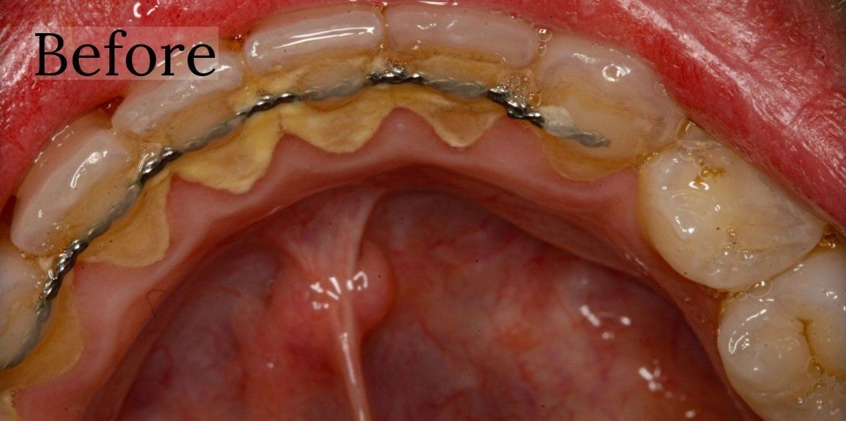 Before and after dental cleaning results at Toschi Dental in San Jose, California
