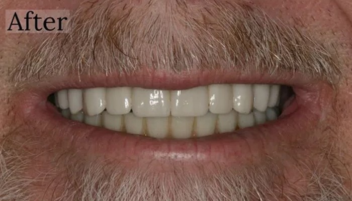 Smile makeover with veneers at Toschi Dental clinic in San Jose, CA