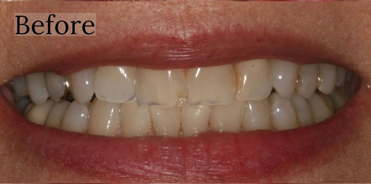 Before teeth transformation results at Toschi Dental in San Jose, California