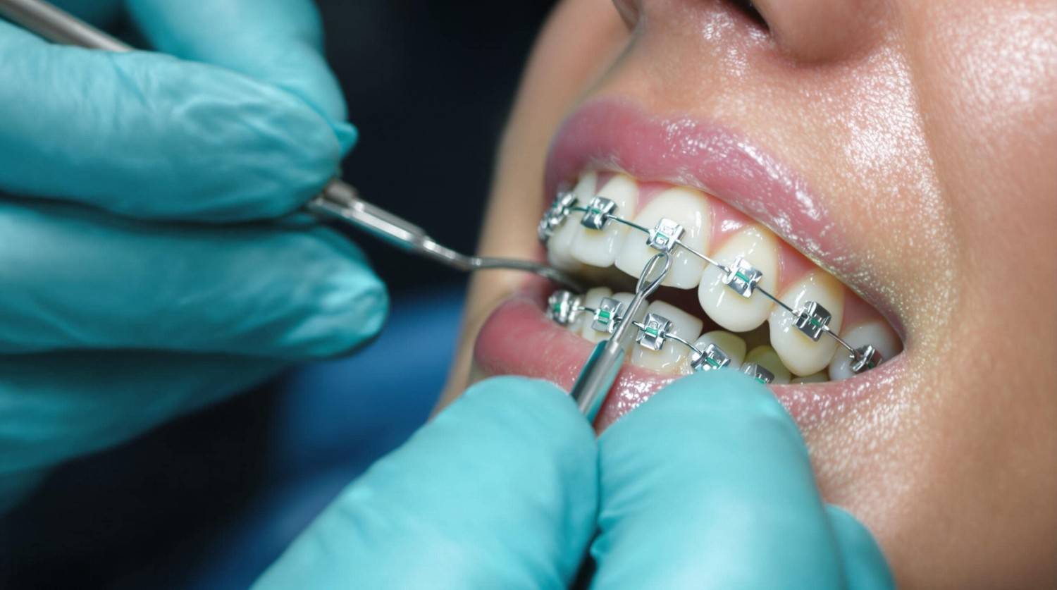 Image of orthodontist adjusting braces for patient in San Jose, CA