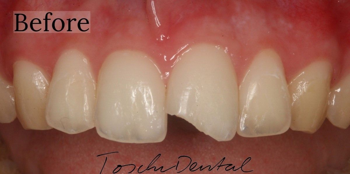 Chipped tooth repaired with dental bonding at Toschi Dental San Jose, CA