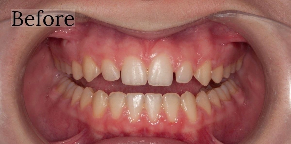 Before and after composite veneers at Toschi Dental in San Jose, California