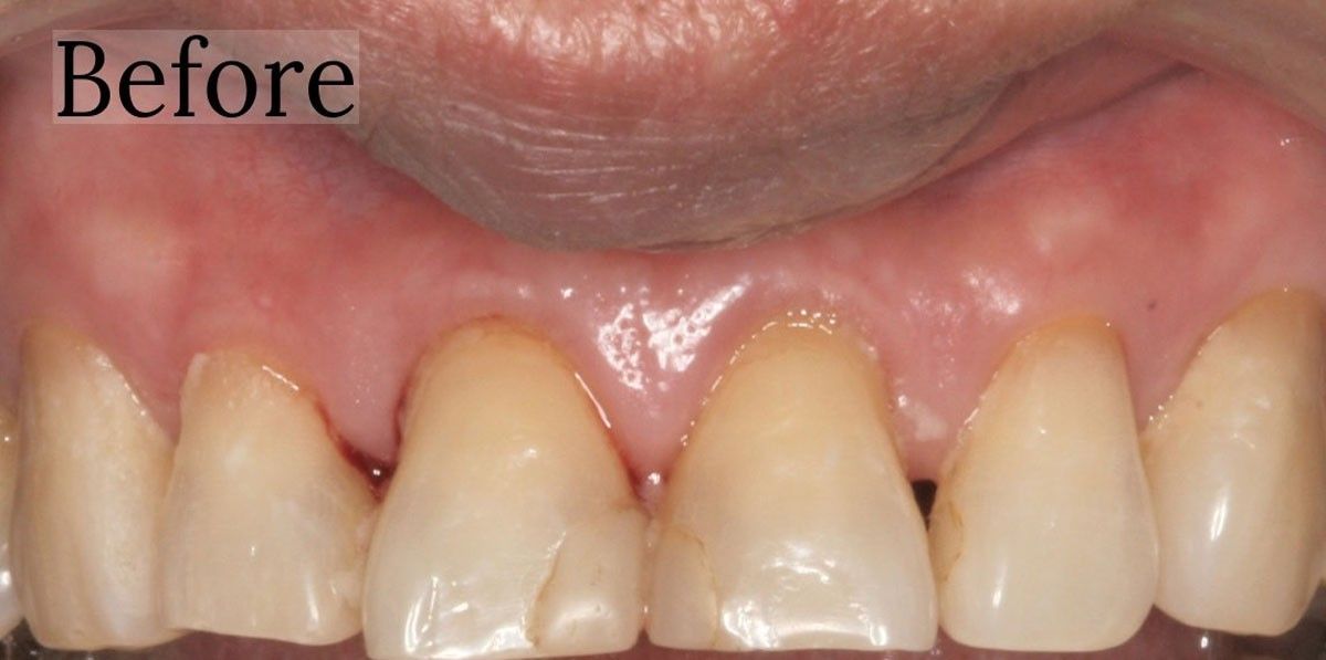 Before dental bonding results at Toschi Dental San Jose, CA