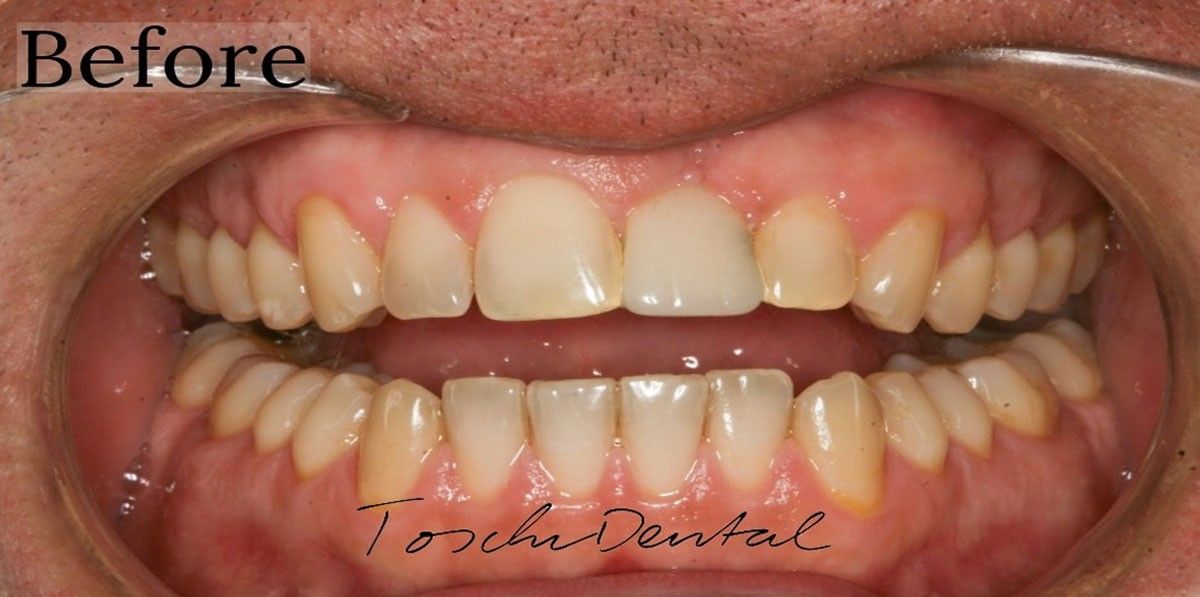 Before dental veneers applied at Toschi Dental clinic in San Jose, California