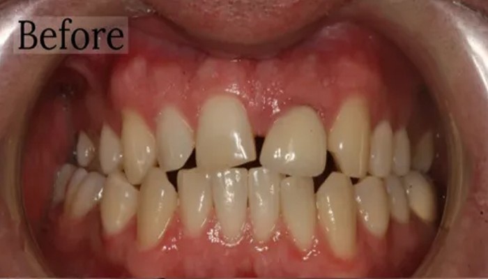 Before and after smile makeover illustration at Toschi Dental San Jose, CA