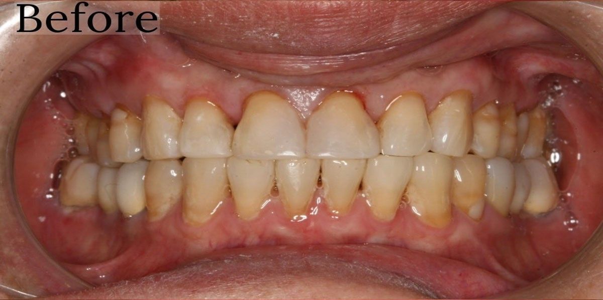 Before smile makeover results at Toschi Dental clinic in San Jose, California