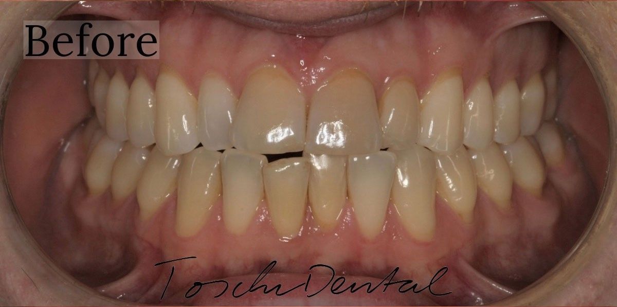 Before teeth alignment treatment at Toschi Dental in San Jose, California