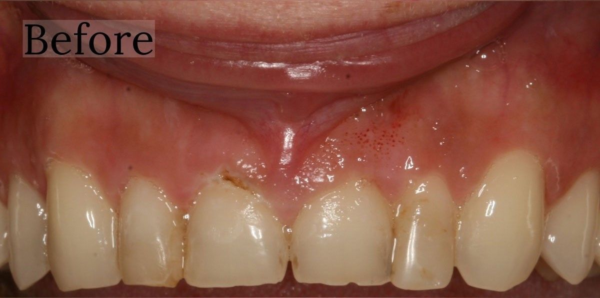 Dramatic teeth transformation at Toschi Dental in San Jose, California