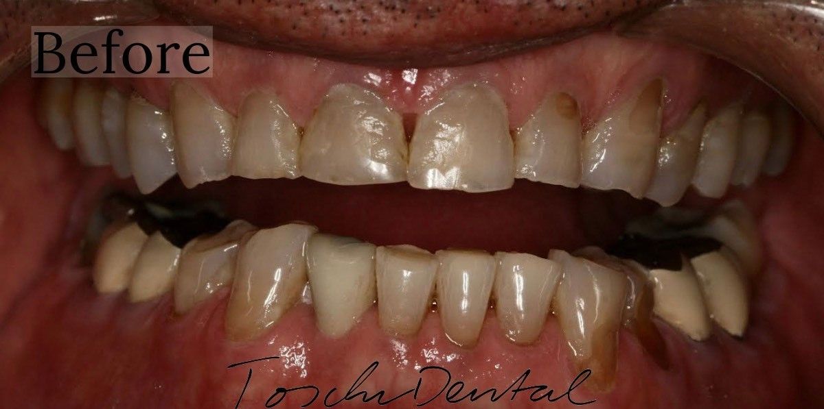 Before veneer transformation by Toschi Dental in San Jose, California