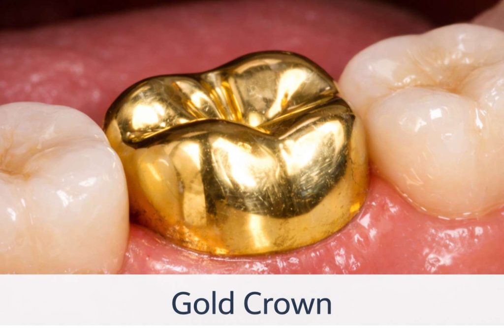 an image of a gold metal crown in san jose ca
