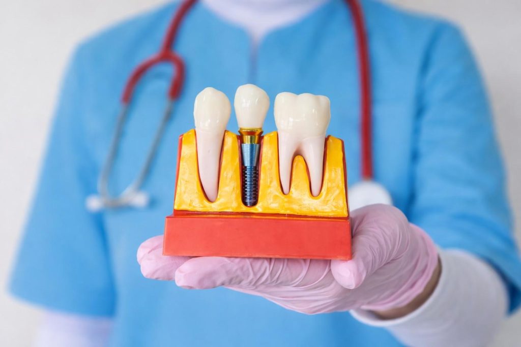 an image of a dental implant sample with a dentist holding the sample on the background