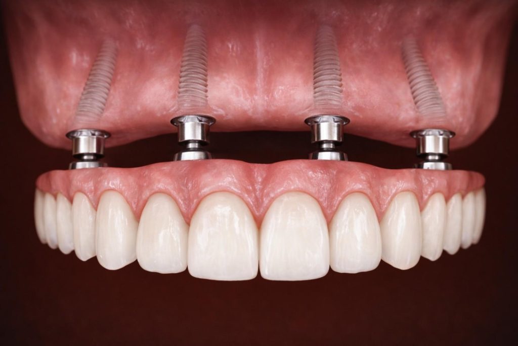 an image of all-on-4 dental implants, a type of dental implant