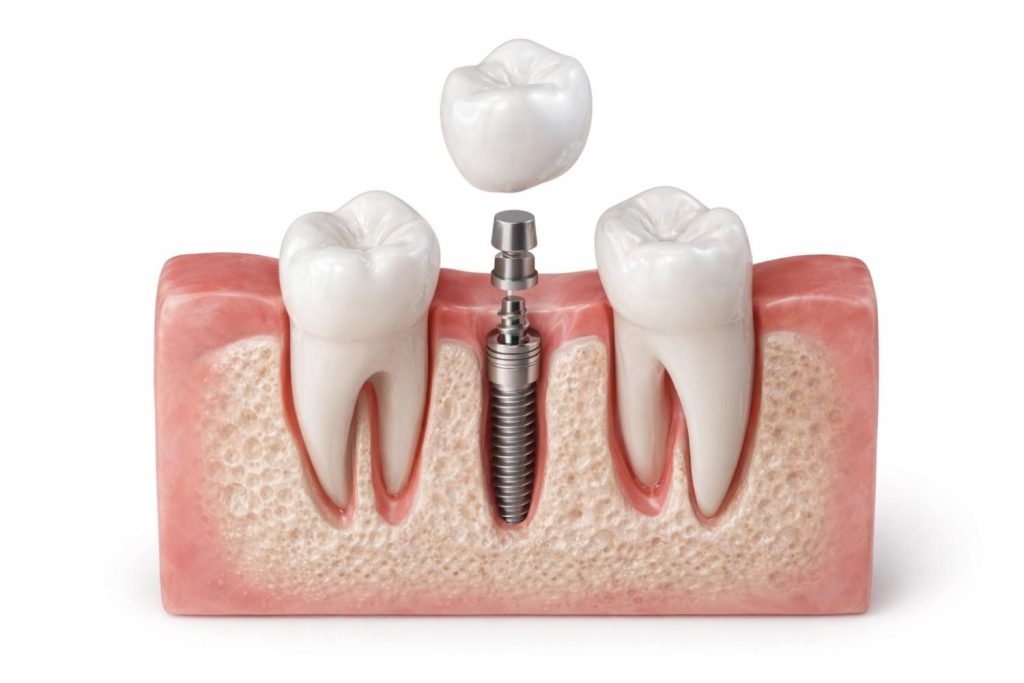an image of endosteal dental implants, a type of dental implant
