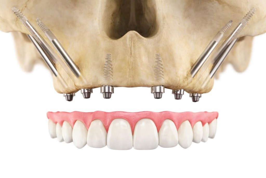 an image of zygomatic dental implants, a type of dental implant