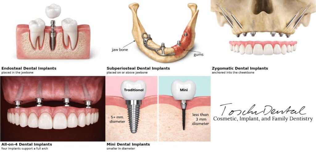 an image comparison of different types of dental implants in San Jose, Ca.